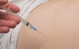 Một phụ nữ bị hoại tử mông do tiêm chất làm đầy: Khi tiến hành phương pháp nâng mông cần chú ý điều gì?