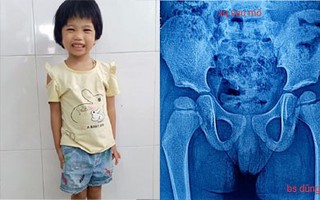 Bị trật khớp háng bẩm sinh, một bé gái may mắn được phẫu thuật và đã có thể đi lại, chạy nhảy bình thường