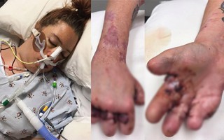 Bị cụt hết ngón chân, vài ngón tay sau biến chứng kinh khủng của căn bệnh mà hầu như ai cũng từng bị nhưng lại rất coi thường