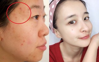 Nhan sắc sẽ tụt hạng nếu mụn quanh trán hoành hành, và đây là 4 nguyên nhân cùng giải pháp xử đẹp tình trạng này