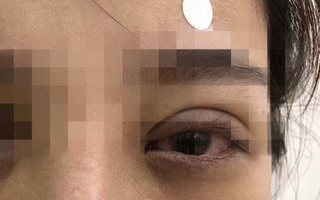 Mắt mờ dần sau nhấn mí ở tiệm spa, cô gái hoảng hốt khi bác sĩ tìm thấy nguyên nhân
