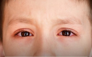 Đau mắt đỏ có thể bùng phát trong mùa hè, muốn phòng bệnh hãy làm đủ 5 việc này mỗi ngày 