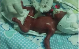 Sinh ra đã lập kỷ lục không ai muốn, thế nhưng bé gái này vẫn làm được điều kì diệu khiến bác sĩ cũng phải cảm động