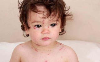 Mùa hè trẻ cũng có thể mắc bệnh thủy đậu: Trẻ bị thủy đậu cần kiêng những gì? 
