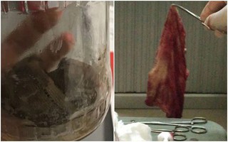 Tái mặt với những thứ "kinh dị" bác sĩ để quên trong bụng sản phụ sau khi sinh mổ
