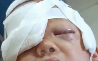 Cháu bé gần 20 tháng tuổi bị chó nhà cắn xé rách vùng đầu mặt