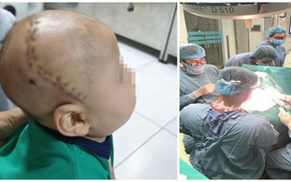 Nới rộng hộp sọ cứu bé 5 tháng không ngóc đầu lên được và có dấu hiệu nhỏ hơn bình thường