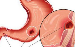 BS cảnh báo: Người trẻ mắc bệnh dạ dày ngày càng nhiều là do đã "cố ý" làm sai 2 điều
