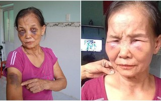 Nàng dâu đánh mẹ chồng đến thâm tím mặt mày lên tiếng: "Tôi chịu đựng đã nhiều, không chịu được nữa mới làm to chuyện"