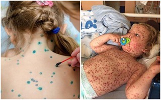 Biến chứng bệnh thủy đậu có thể gây viêm não, tử vong: Cha mẹ đừng chủ quan mà có thể mất con