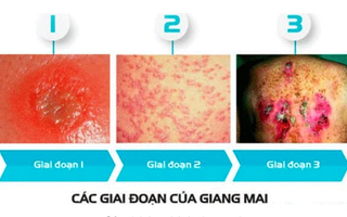 Tái mặt khi con mới 13 tuổi đã mắc lậu, giang mai