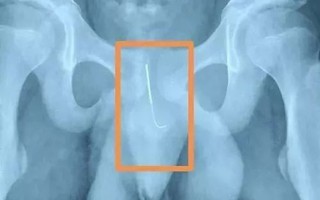 Vì áp lực thành tích, cậu bé 12 tuổi tự đâm kim châm cứu vào dương vật để tỉnh ngủ khi làm bài tập về nhà