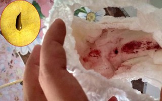 Thấy vùng kín của con gái chảy máu, bà mẹ thất kinh khi biết sinh vật này đã hút no nê máu của con mình