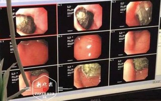 Cậu bé 7 tuổi bị nôn ói dữ dội, nhập viện đến bác sĩ cũng sốc khi phát hiện “dị vật” này trong dạ dày