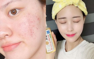 Dùng dầu tẩy trang mà mụn nổi ồ ạt: Sản phẩm không có tội, lỗi là do bạn không biết cách dùng