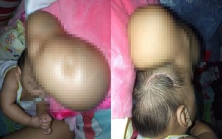 Xót xa hình ảnh cô bé 11 tháng tuổi đầu phình to như quả bóng vì bẩm sinh đã mắc 1 bệnh quái ác