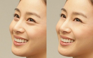 Cắt mỡ bọng mắt để trẻ hóa nhưng trước khi làm hãy chú ý khuyến cáo của chuyên gia