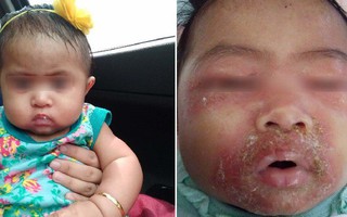 Sau một lần con gái mắc bệnh nhiễm trùng da nghiêm trọng, người mẹ này đã quyết định không bao giờ để người khác động vào con mình 