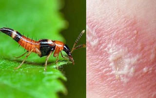 Dại dột lấy nọc kiến ba khoang chữa nấm da, thanh niên hoại tử "vùng kín"