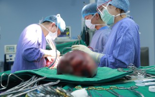 Cắt bỏ khối u gan khổng lồ là nang ung thư hóa chiếm gần hết ổ bụng với đường kính trên 30cm