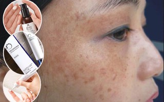 Từ câu chuyện trị nám 5 năm không hết, các chị em rút kinh nghiệm phòng và trị ngay từ sớm bằng 7 sản phẩm chuyên dụng này