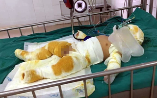 Yên Bái: Bất cẩn khi đun nấu, cha mẹ cùng con trai 7 tháng tuổi bị bỏng nặng