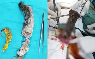 Choáng: Bé gái 5 tuổi mắc hội chứng thích ăn tóc của mình hoặc tóc búp bê, bác sĩ chỉ ra 2 nguyên nhân cha mẹ cần cảnh giác