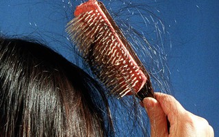 Áp lực thi cử quá lớn khiến bé gái 13 tuổi học đến hói đầu, lông mi, lông mày cũng rụng sạch