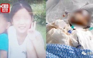 Rủ bạn hàng xóm dùng lon làm bỏng ngô tại nhà, bé gái 14 tuổi bị bỏng nặng, tính mạng ngàn cân treo sợi tóc