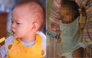 Cha mẹ mù quáng cho con ăn chay, bé gái 19 tháng tuổi bị suy dinh dưỡng, co giật và cân nặng chưa được 5kg