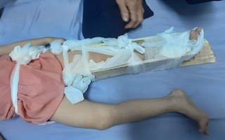Hiệu trưởng bảo "hơi thừa" khi phụ huynh báo con gãy chân: Do điện thoại tậm tịt nên hiểu lầm?