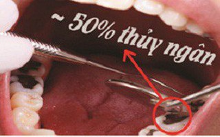 Amalgam – loại vật liệu hàn răng chứa Thủy ngân cần được loại bỏ