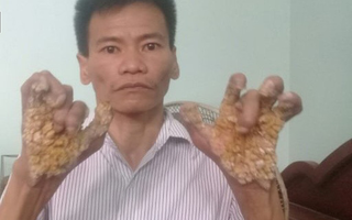 Người cây ở Ninh Bình: Số phận cay đắng vì mắc căn bệnh ngoài da khủng kiếp nhất thế giới