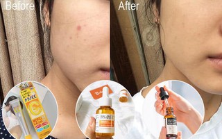 4 lọ serum đỉnh cao giá dưới 300k giúp bạn tạm biệt tình trạng "thu đi để lại lá vàng, mụn đi để lại muôn vàn vết thâm"