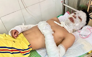 Bật lửa đốt dây bóng bay, 4 người phải nhập viện cấp cứu