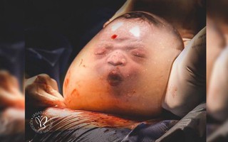 Việc mẹ bầu cần làm khi được bác sĩ chẩn đoán bị đa ối để không gây biến chứng cho con