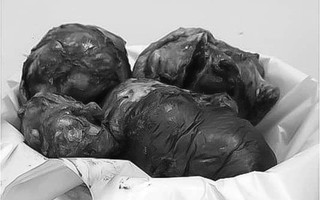 Nghe lời mẹ đi khám sức khỏe, người đàn ông 40 tuổi phát hiện mình suýt chết vì 3 khối u "khủng" trong bụng
