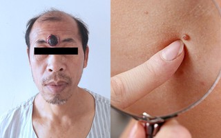 Bỗng dưng mọc thêm “mắt thứ 3”, người đàn ông sốc khi biết mình đã mắc loại ung thư này 