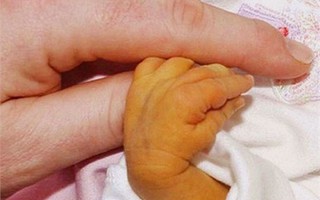 Bố mẹ xem thường bệnh vàng da, bé 7 ngày tuổi đã phải thay máu, tiên lượng nặng