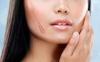 Chuyên gia chỉ ra cách phân biệt sẹo lồi và sẹo phì đại chuẩn xác để tìm ra hướng điều trị đúng