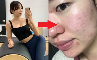 Từ nổi mụn đến lão hóa nhanh, da bạn sẽ phải đối mặt với ít nhất 5 rủi ro khi tập thể dục