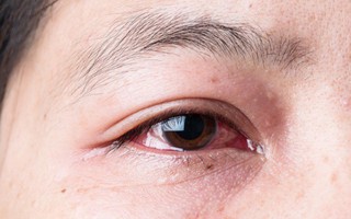 Tối nào cũng làm một việc không nên làm cùng với bạn bè, cô gái 29 tuổi bị bệnh nghiêm trọng về mắt