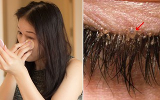 Bài học cho chị em thích trang điểm: Vô số bọ ve "làm tổ" ở lông mi người phụ nữ 32 tuổi vì không tẩy trang cuối ngày