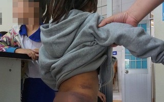 Bốn em nhỏ ở Cà Mau nghi bị người thân đánh thâm tím cơ thể