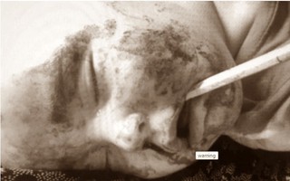 Đang chập chững tập đi, bé trai 14 tháng tuổi bị ngã và cây bút chì xuyên thẳng vào vòm miệng