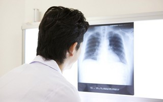 Ho 4 tuần nhưng không đi khám, người đàn ông khiến bác sĩ choáng vì toàn bộ phổi bị lấp đầy bởi thứ nguy hiểm