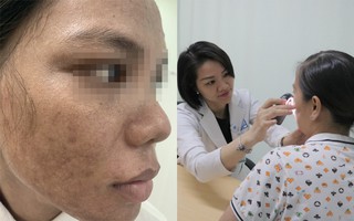 Cô gái 26 tuổi mặt loang lổ, đầy mụn mủ vì tự ý xài kem trộn mua qua mạng và thuốc "dỏm" trị nám da