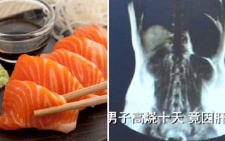 Bác sĩ sốc nặng khi thấy kí sinh trùng bò lổm ngổm trong gan của người đàn ông, "thủ phạm" là món hải sản anh vẫn ăn