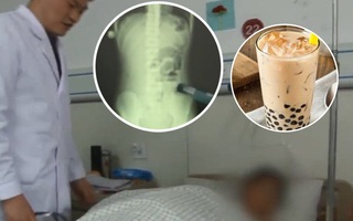 Đau bụng không chịu nổi, đi khám bác sĩ nói tắc ruột, hóa ra nguyên nhân là do nhai viên trân châu trong trà sữa trân châu không đúng cách