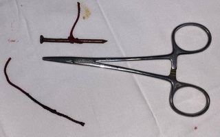 Tai nạn kinh hoàng lúc làm việc: Người đàn ông bị cây đinh cắm thẳng vào mắt trái, phải múc bỏ nhãn cầu